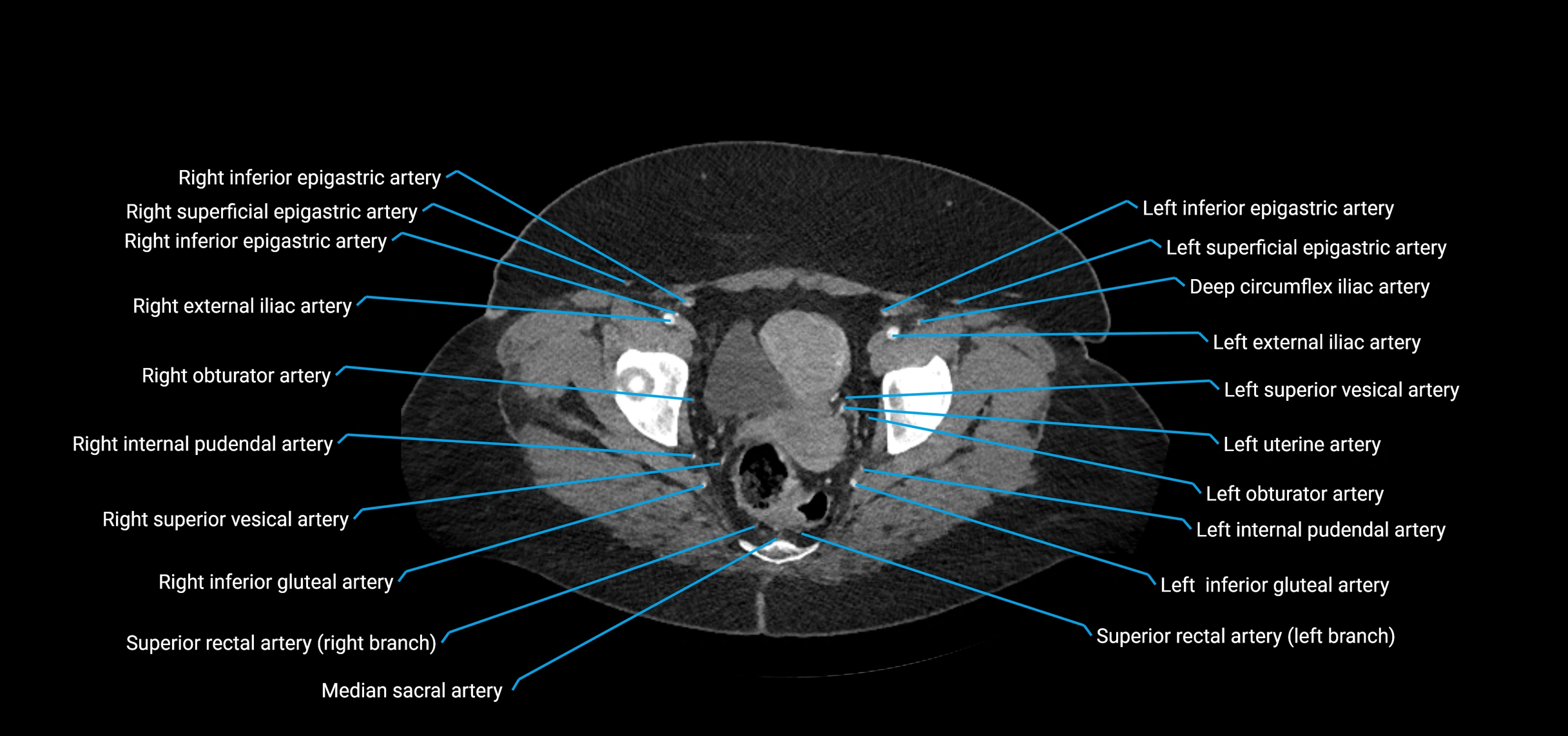 CTA abdomen axial cross sectional anatomy labelled image_233 (1).webp